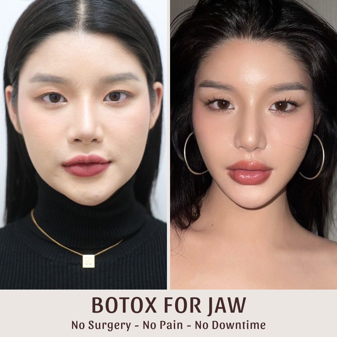 Botox