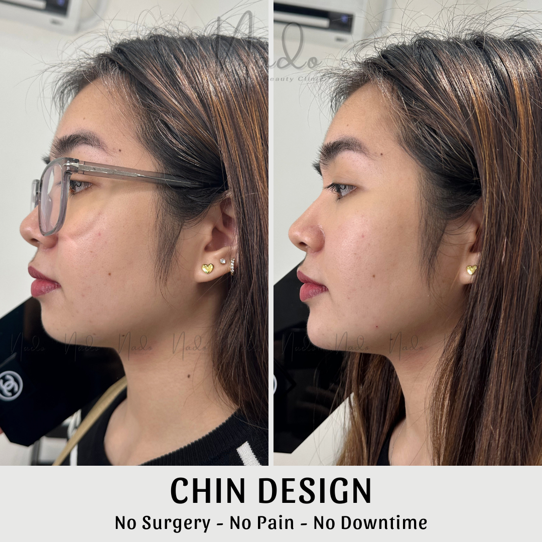 Chin Design