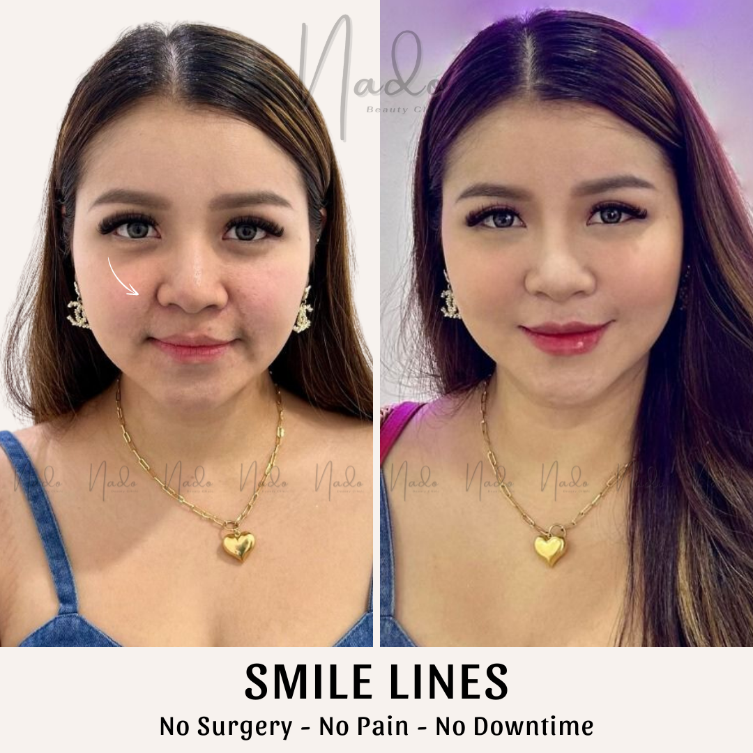 Smile lines