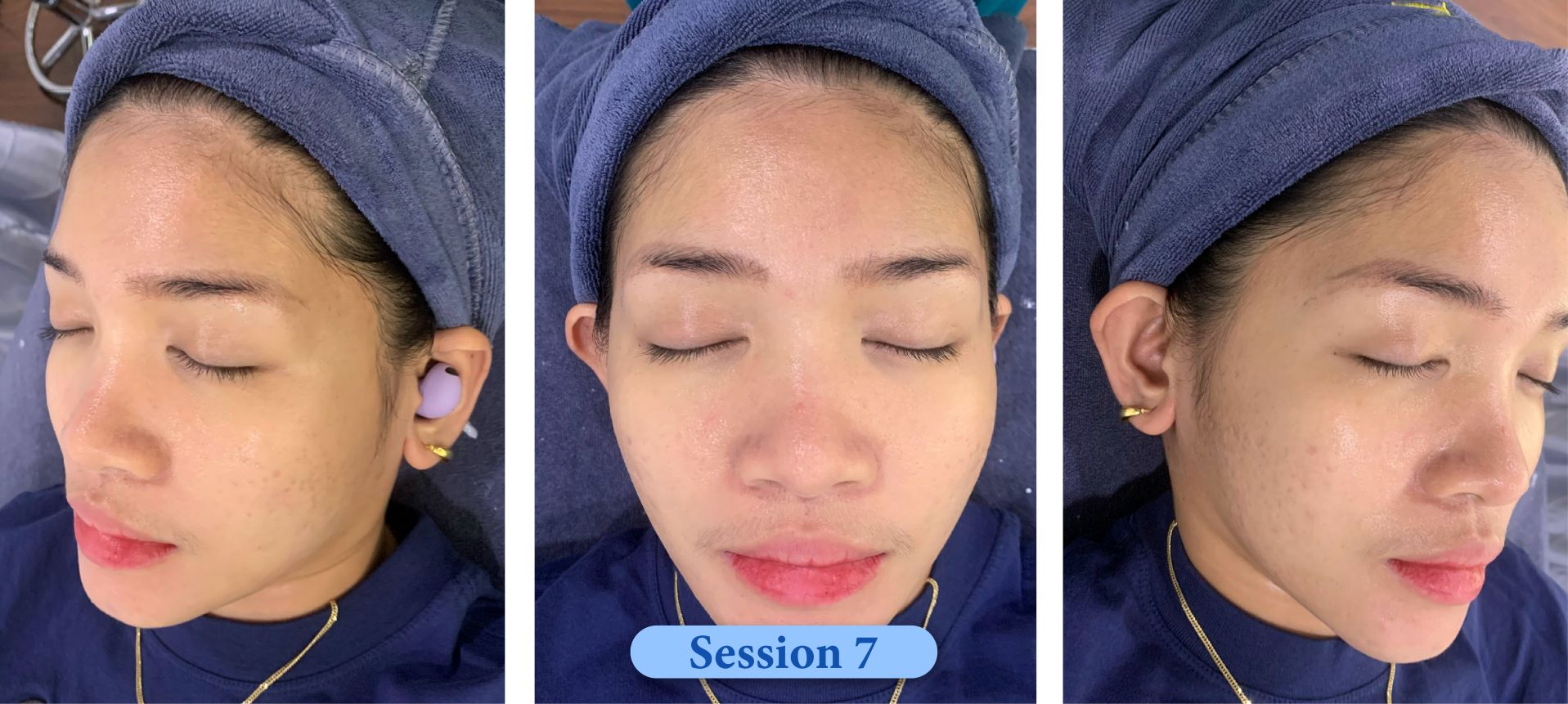 Acne Treatment