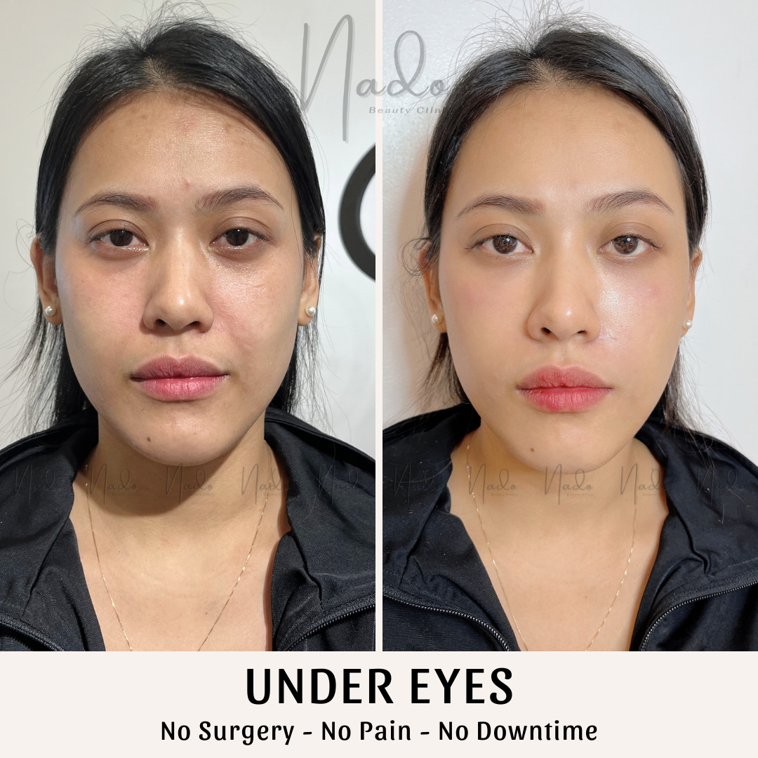 Under Eyes