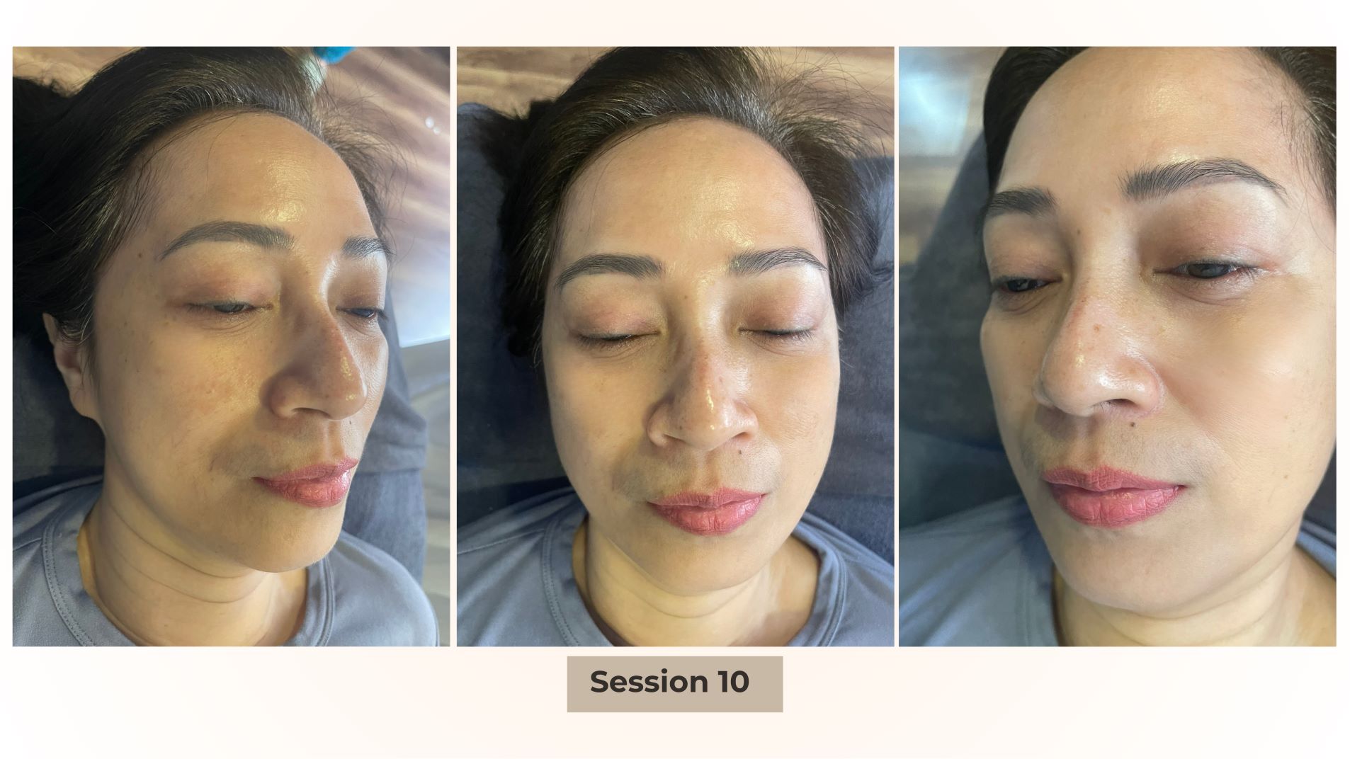 
											Melasma Treatment
											
