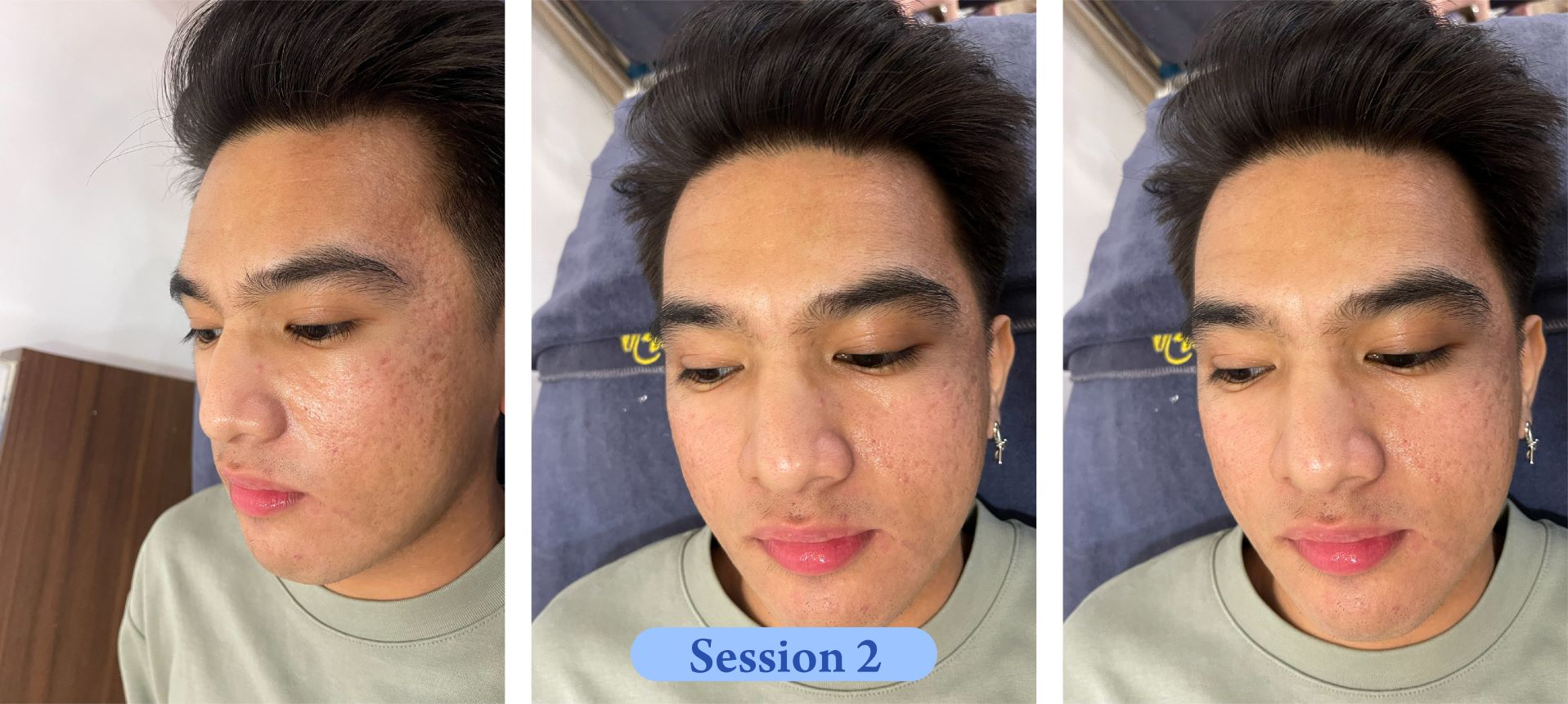 Scar Treatment