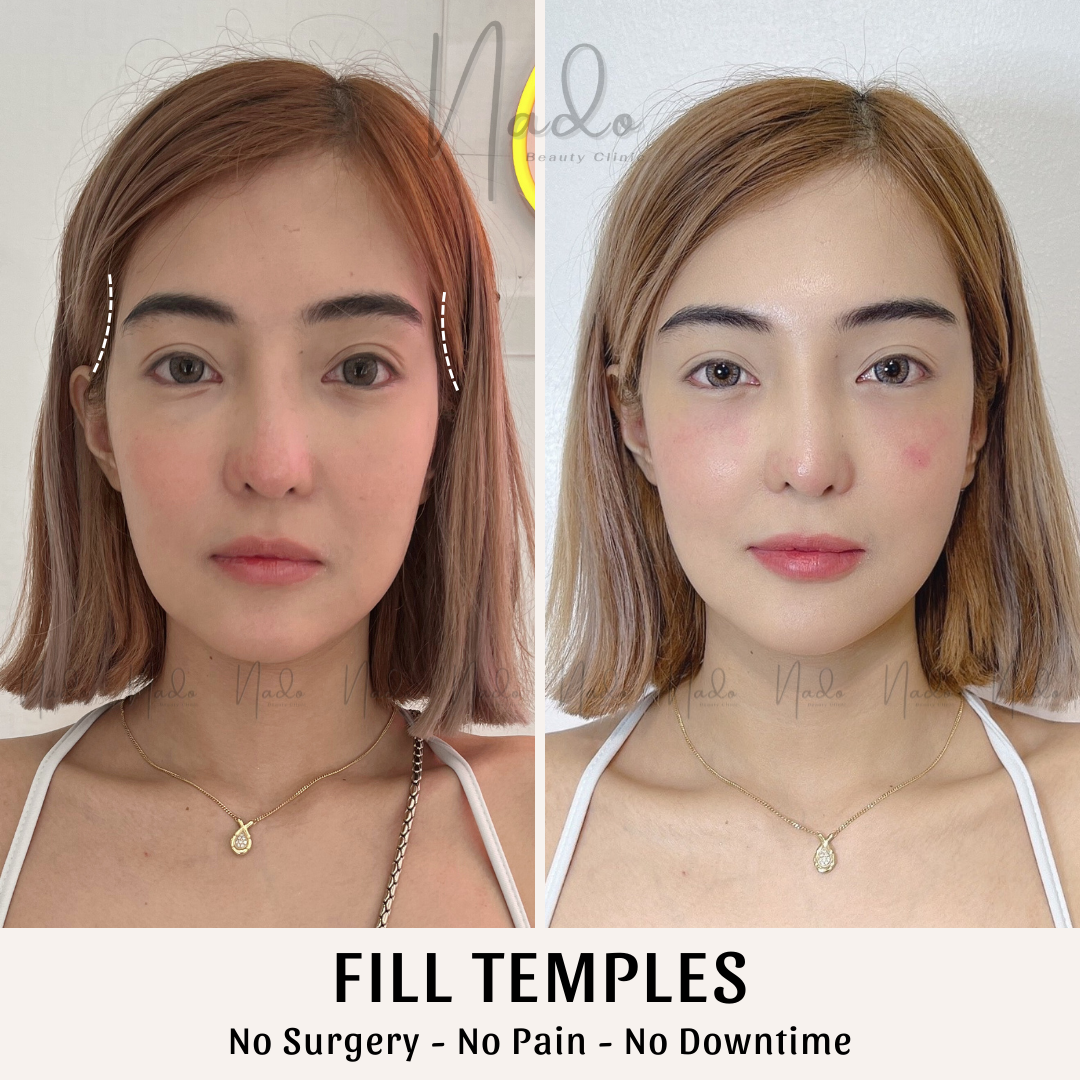 Fill Temples